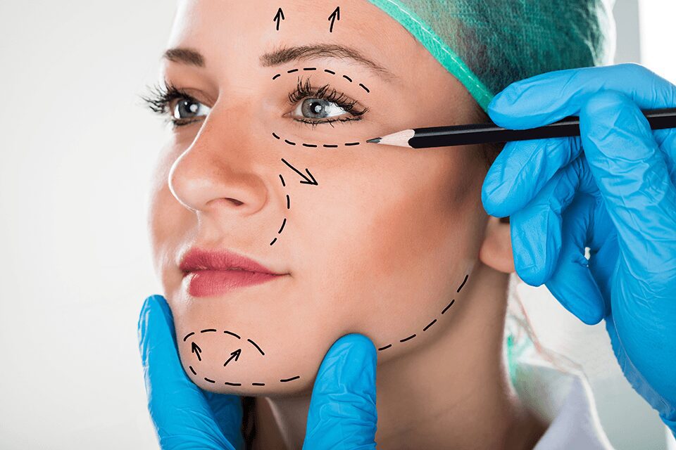Woman's face marked for cosmetic surgery procedure.