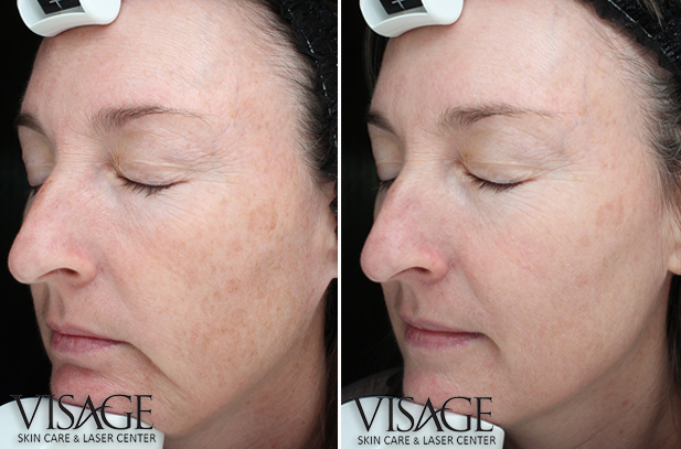 Fractional CO2 Laser Before & After - Charlotte Huntersville, NC: Saluja  Cosmetic and Laser Center