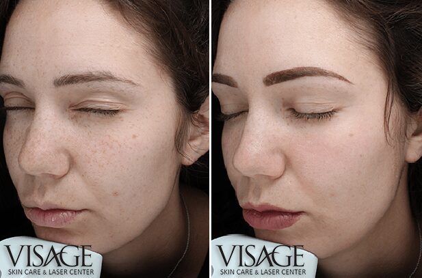 Before and after skin treatment comparison.