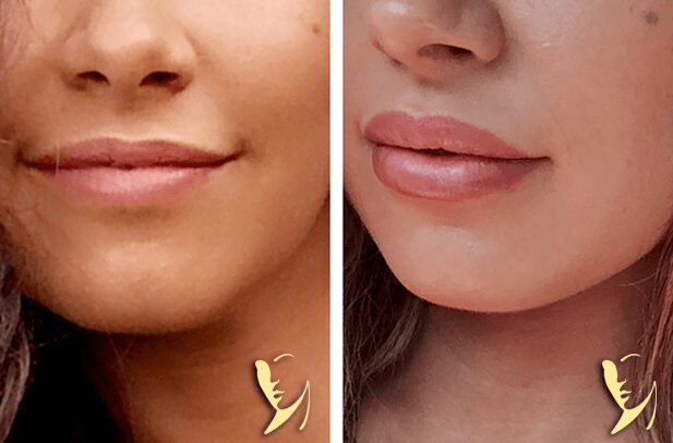 Lip-Enhancement-3