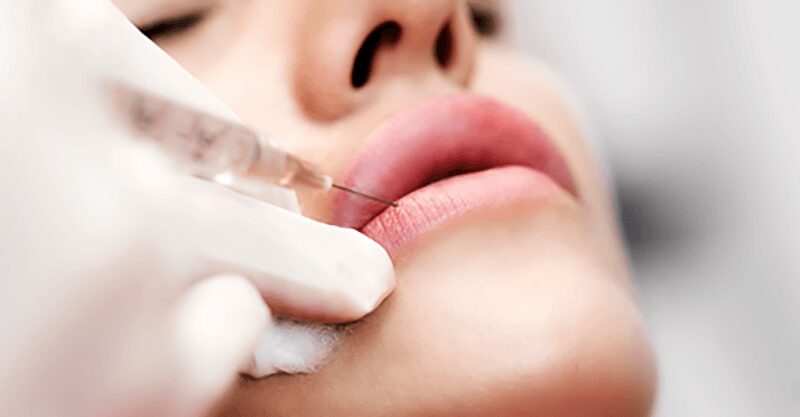 Restylane Kysse Image