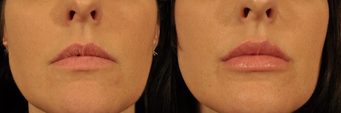 before and after lip filler