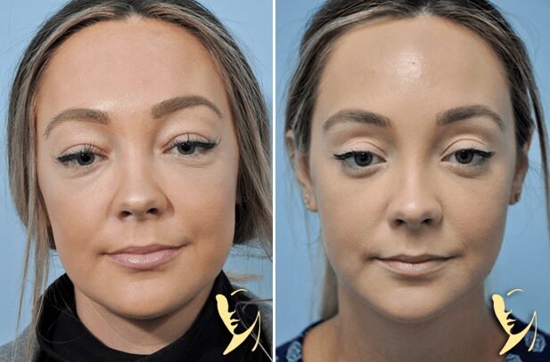 Upper-and-Lower Eyelid-Before-and After-50