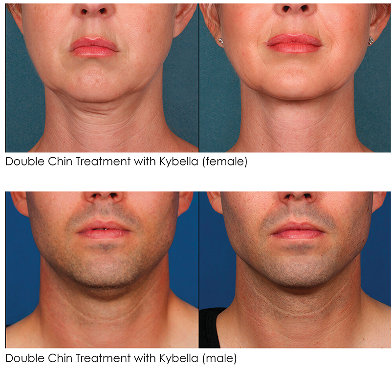 Kybella Before And After Robinson Fps
