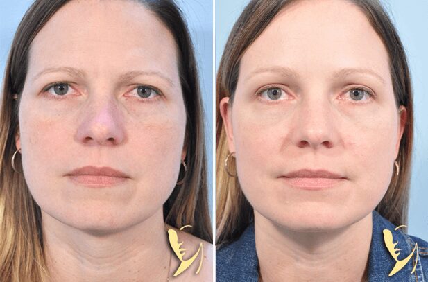 browlift-before-after-result
