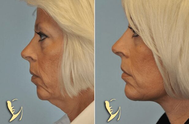facelift-image