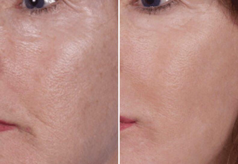 laser peel patient results in atlanta