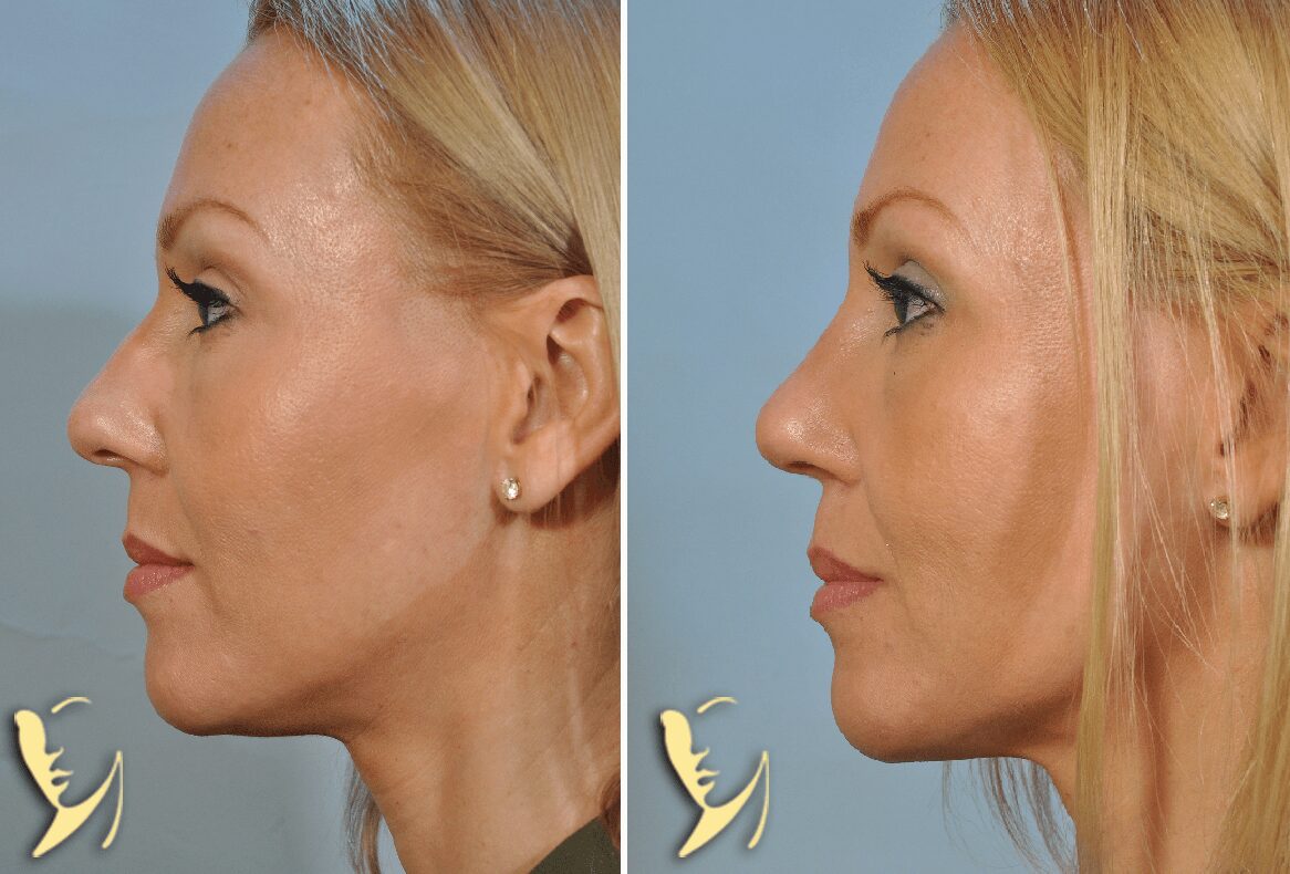 rhinoplasty before and after