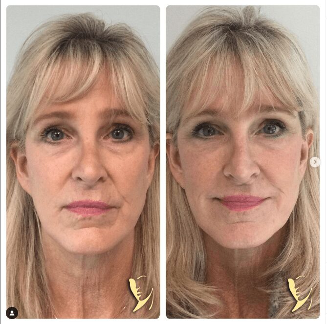 before and after